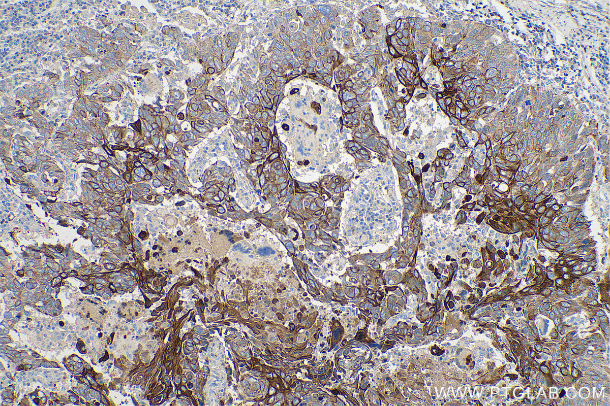 Immunohistochemical analysis of paraffin-embedded human lung cancer tissue slide using KHC0746 (KRT5/6 IHC Kit).