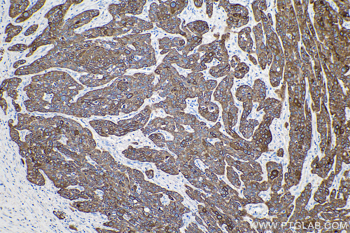 Immunohistochemical analysis of paraffin-embedded human oesophagus cancer tissue slide using KHC0746 (KRT5/6 IHC Kit).