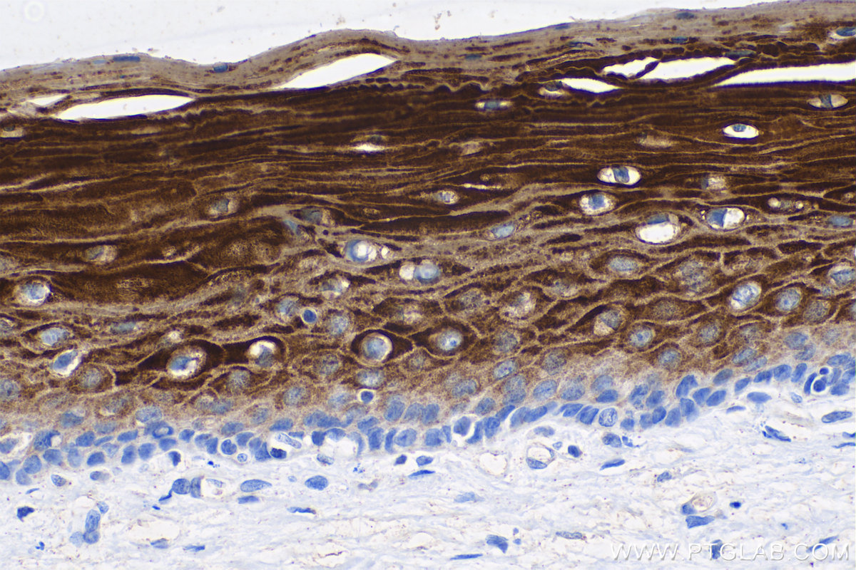 Immunohistochemical analysis of paraffin-embedded human cervical cancer tissue slide using KHC0747 (KRT6 IHC Kit).