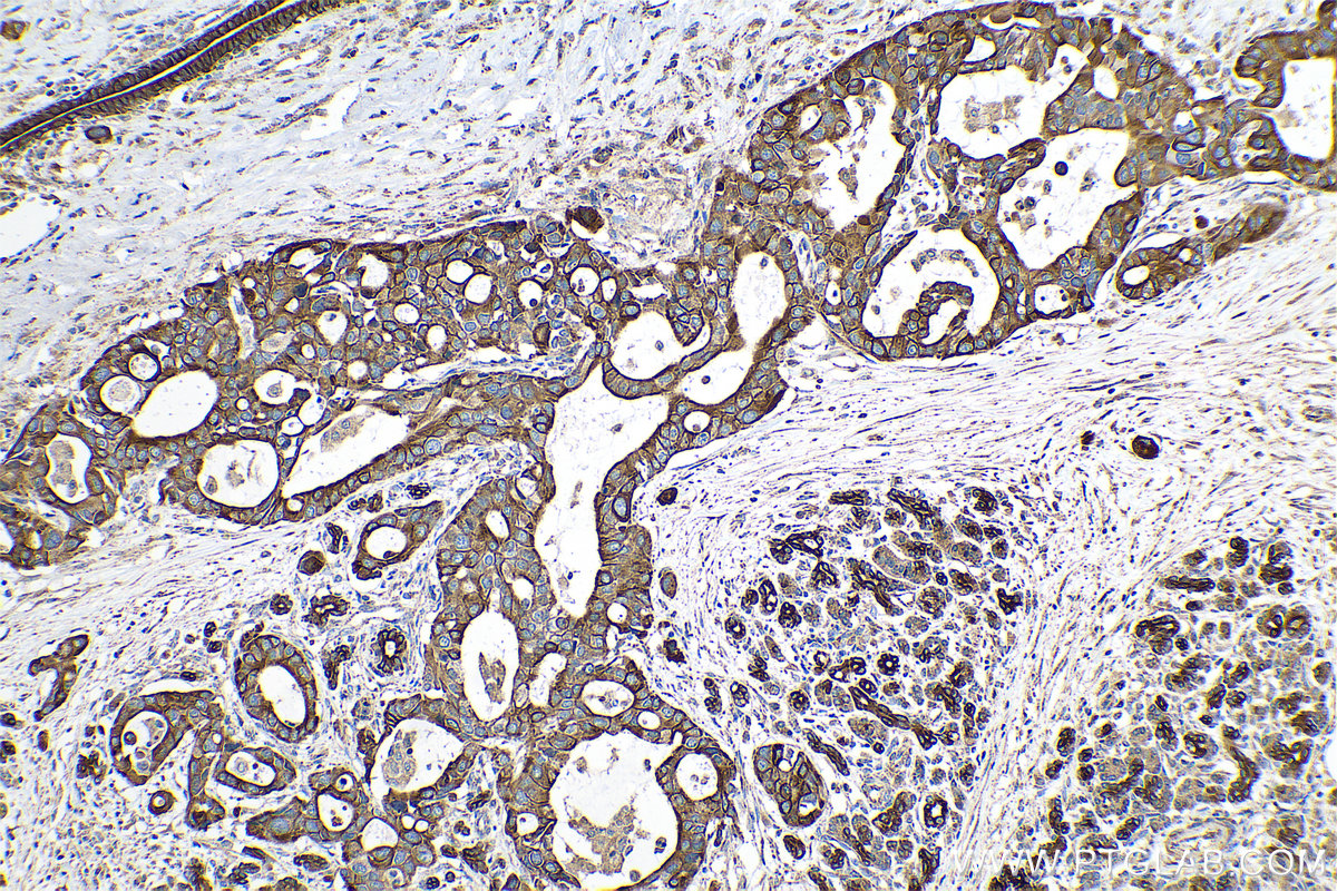 Immunohistochemical analysis of paraffin-embedded human pancreas cancer tissue slide using KHC0756 (KRT81 IHC Kit).