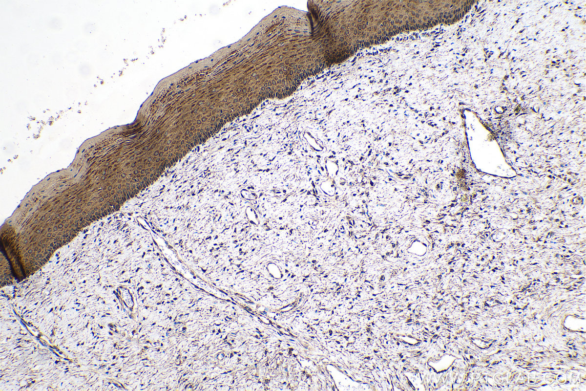 Immunohistochemical analysis of paraffin-embedded human cervical cancer tissue slide using KHC0756 (KRT81 IHC Kit).