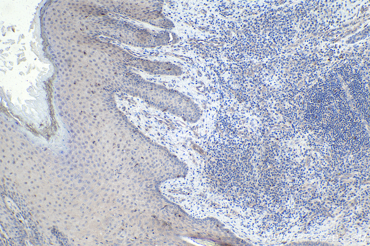 Immunohistochemical analysis of paraffin-embedded human skin cancer tissue slide using KHC1785 (Kazrin IHC Kit).