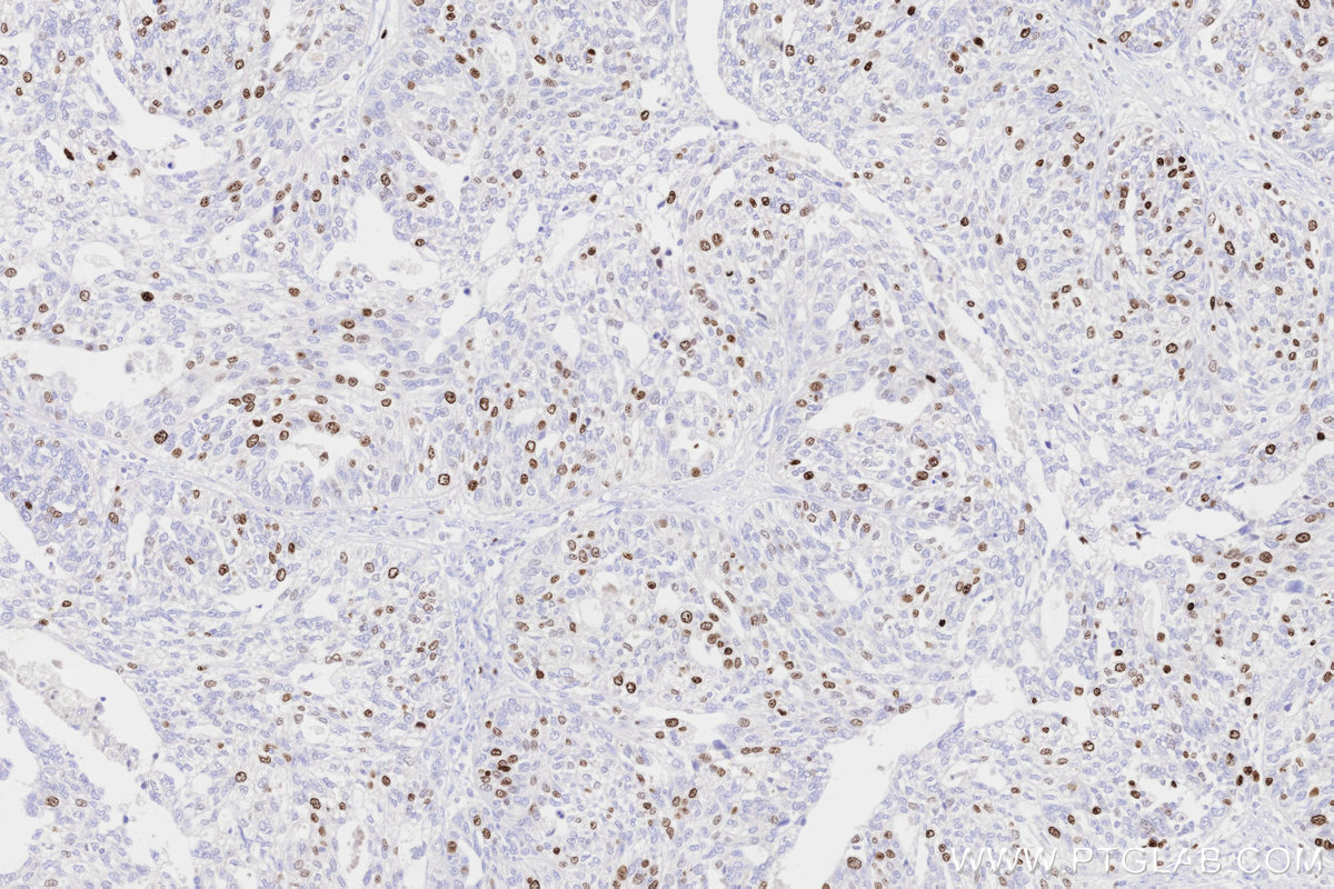 Immunohistochemical analysis of paraffin-embedded human ovary cancer tissue slide using KHC3316 (Ki-67 IHC Kit). Immunohistochemical analysis of paraffin-embedded human ovary cancer tissue slide using KHC3316 (Ki-67 IHC Kit).