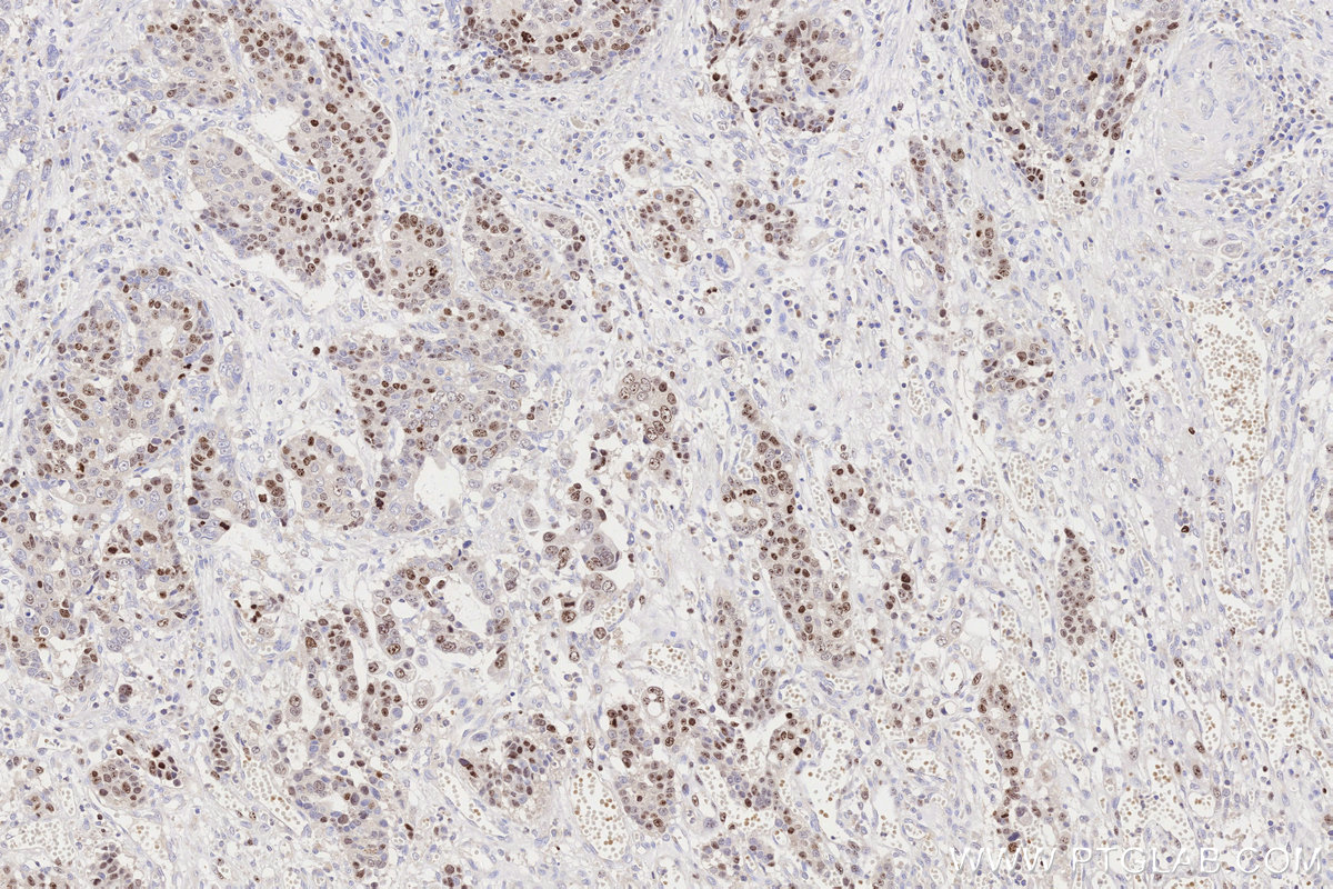 Immunohistochemical analysis of paraffin-embedded human stomach cancer tissue slide using KHC3316 (Ki-67 IHC Kit). Immunohistochemical analysis of paraffin-embedded human stomach cancer tissue slide using KHC3316 (Ki-67 IHC Kit).