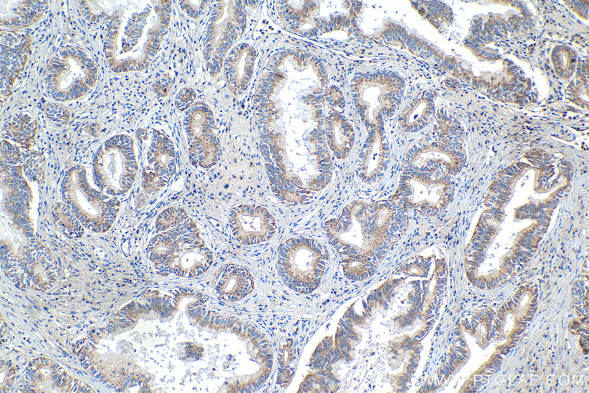 Immunohistochemical analysis of paraffin-embedded human pancreas cancer tissue slide using KHC1363 (LAMP2 IHC Kit).