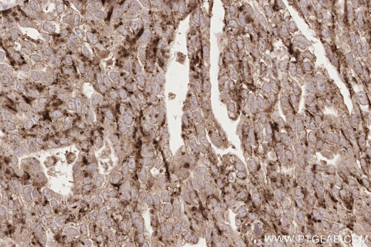 Immunohistochemical analysis of paraffin-embedded human ovary cancer tissue slide using KHC2577 (LAMTOR1 IHC Kit).