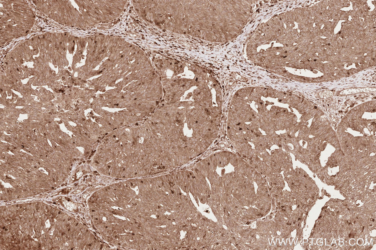 Immunohistochemical analysis of paraffin-embedded human ovary cancer tissue slide using KHC2609 (LARP4 IHC Kit).