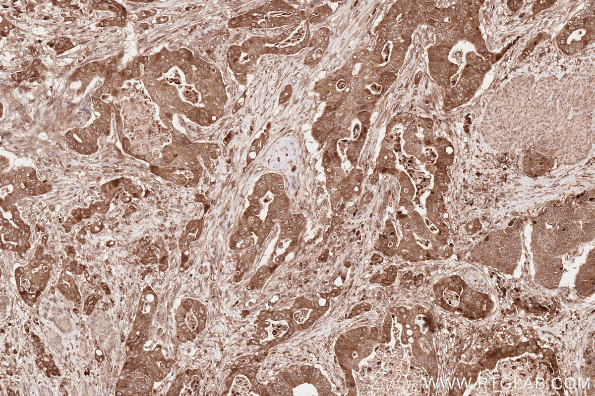 Immunohistochemical analysis of paraffin-embedded human stomach cancer tissue slide using KHC2609 (LARP4 IHC Kit).