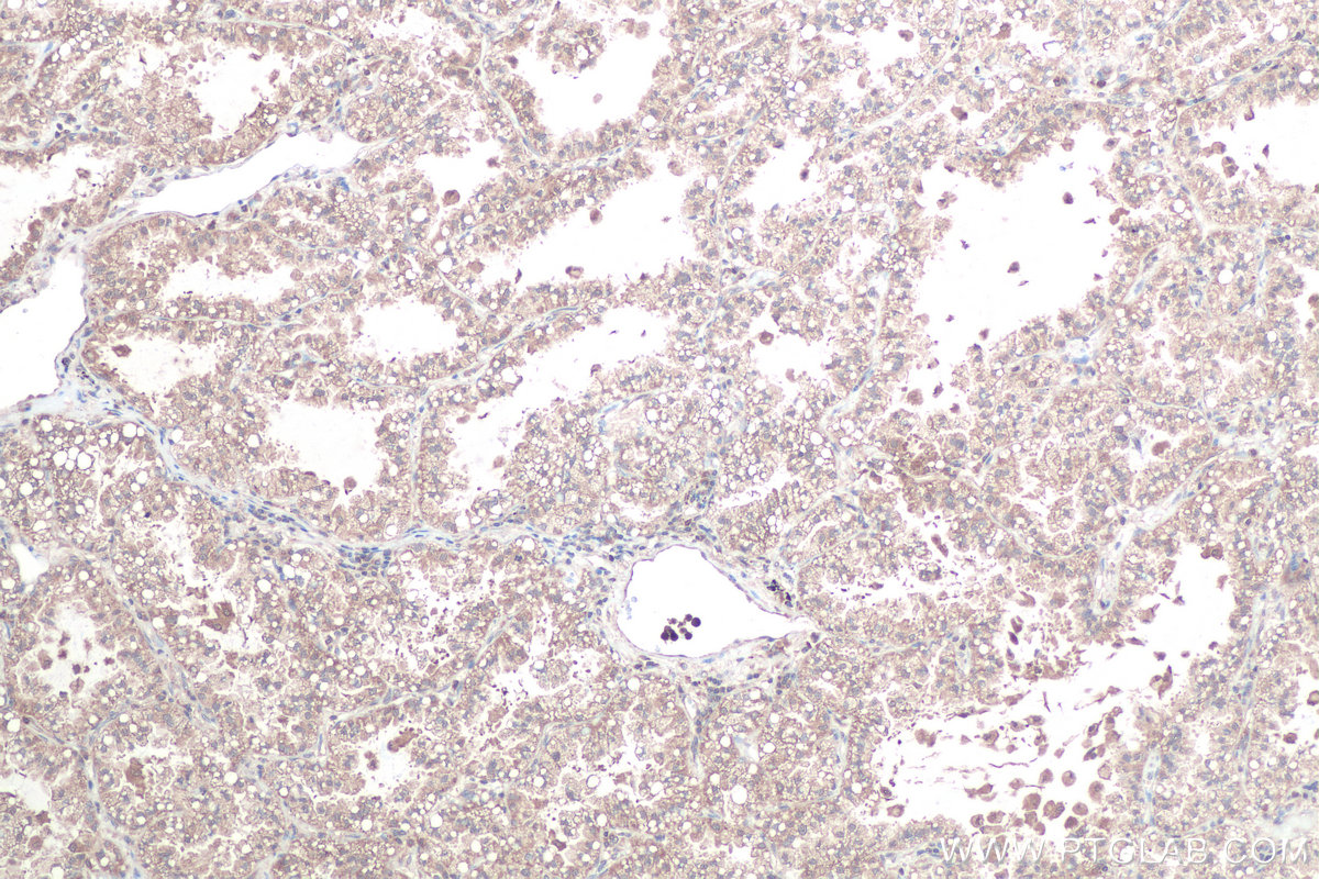 Immunohistochemical analysis of paraffin-embedded human lung cancer tissue slide using KHC0866 (LARS1 IHC Kit).