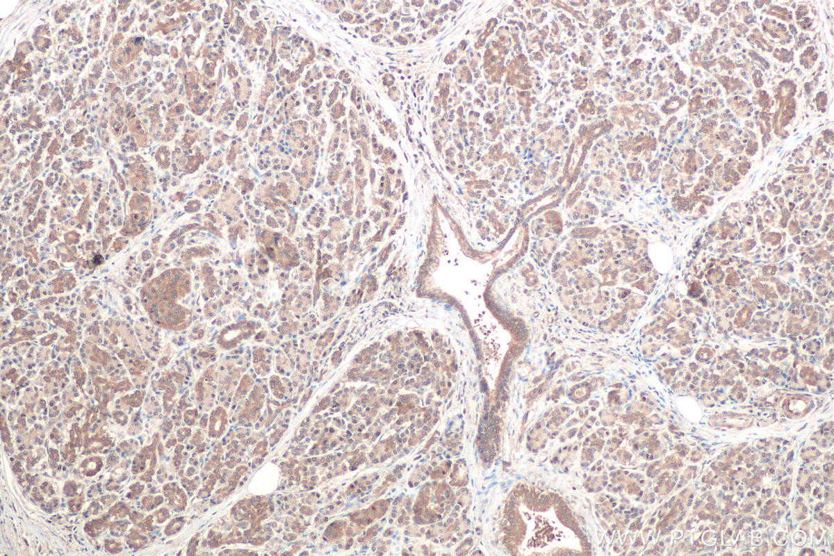 Immunohistochemical analysis of paraffin-embedded human pancreas cancer tissue slide using KHC0866 (LARS1 IHC Kit).