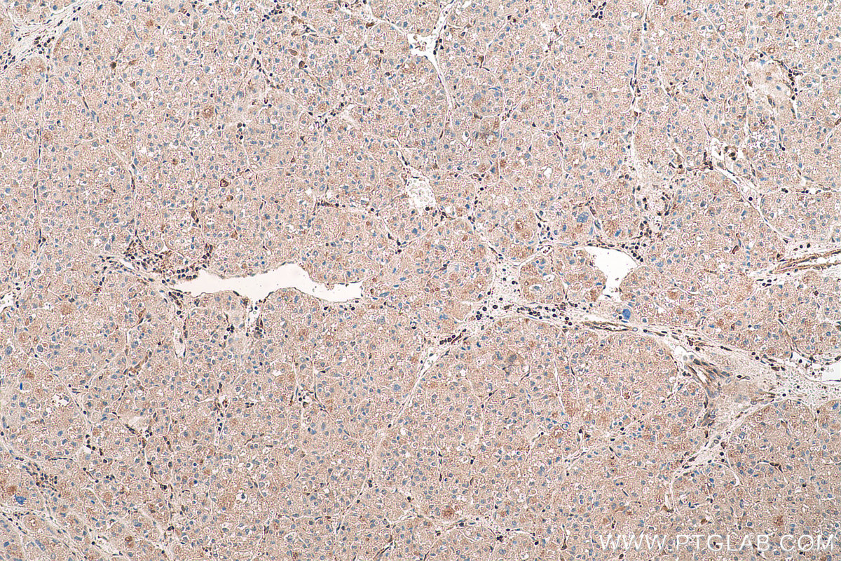 Immunohistochemical analysis of paraffin-embedded human liver cancer tissue slide using KHC0676 (LASP1 IHC Kit).