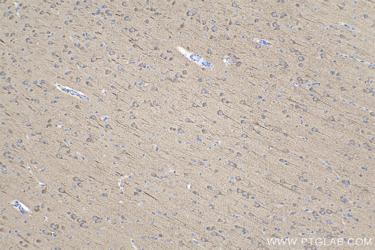 Immunohistochemical analysis of paraffin-embedded human gliomas tissue slide using KHC0939 (LC3A/B IHC Kit).