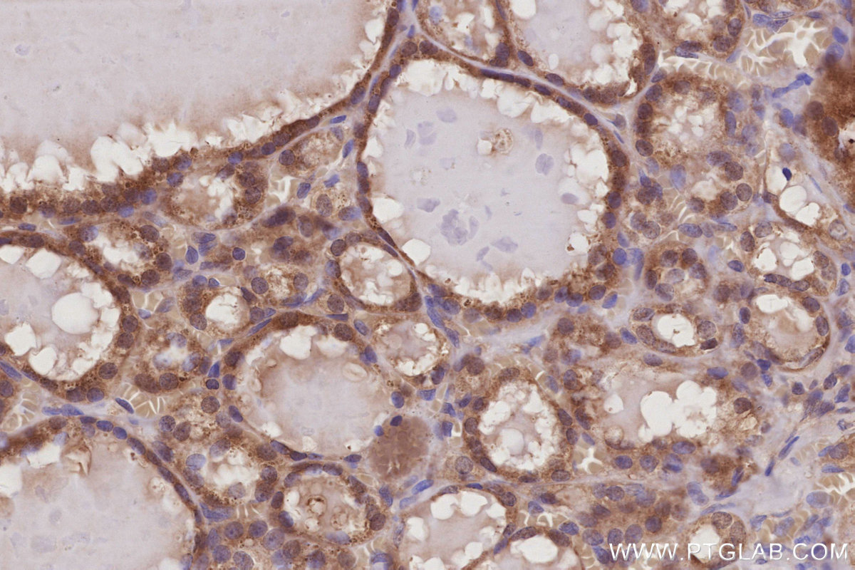 Immunohistochemical analysis of paraffin-embedded human thyroid cancer tissue slide using KHC3012 (LCMT1 IHC Kit). Immunohistochemical analysis of paraffin-embedded human thyroid cancer tissue slide using KHC3012 (LCMT1 IHC Kit).