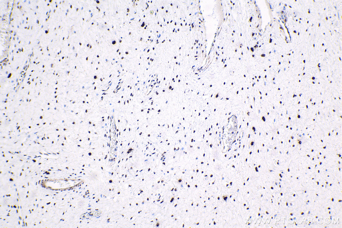 Immunohistochemical analysis of paraffin-embedded human cervical cancer tissue slide using KHC1808 (LDB1 IHC Kit).