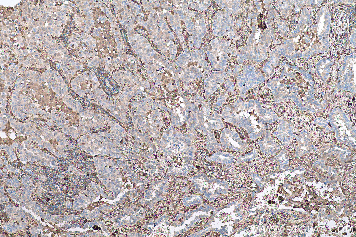 Immunohistochemical analysis of paraffin-embedded human lung cancer tissue slide using KHC0826 (LGALS1 IHC Kit).