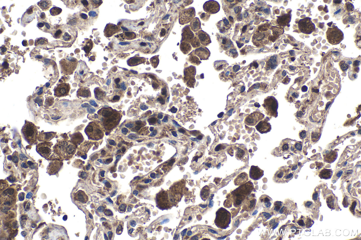 Immunohistochemical analysis of paraffin-embedded human lung tissue slide using KHC1418 (LGALS9 IHC Kit).