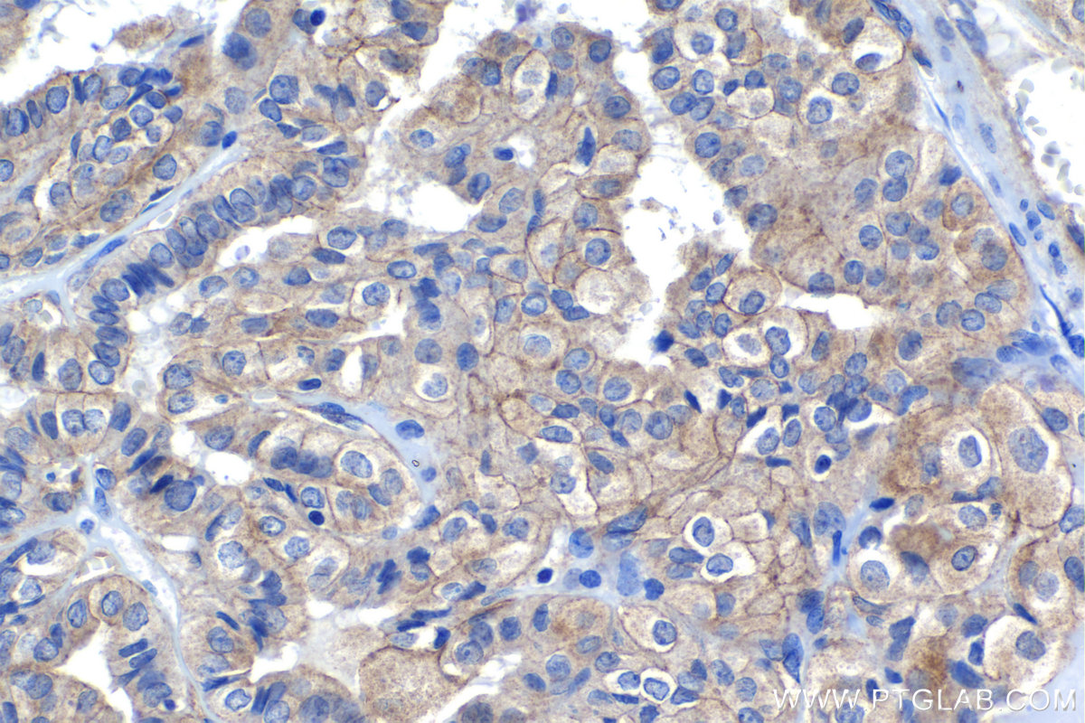 Immunohistochemical analysis of paraffin-embedded human thyroid cancer tissue slide using KHC1180 (LIMCH1 IHC Kit).