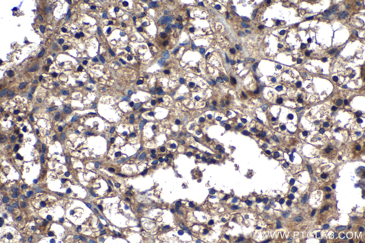 Immunohistochemical analysis of paraffin-embedded human renal cell carcinoma tissue slide using KHC1364 (LMAN2 IHC Kit).
