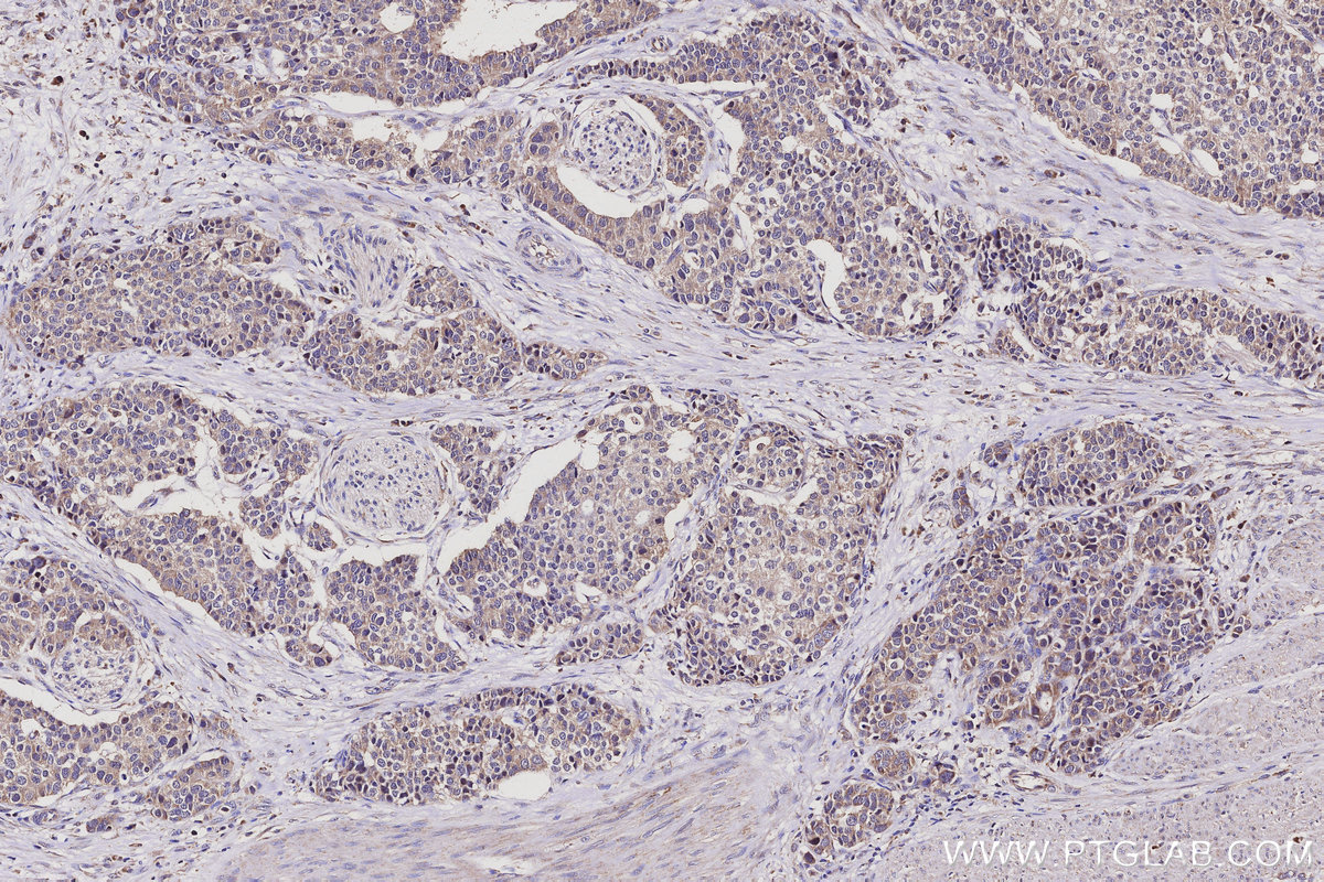 Immunohistochemical analysis of paraffin-embedded human stomach cancer tissue slide using KHC3116 (LMF2 IHC Kit). Immunohistochemical analysis of paraffin-embedded human stomach cancer tissue slide using KHC3116 (LMF2 IHC Kit).