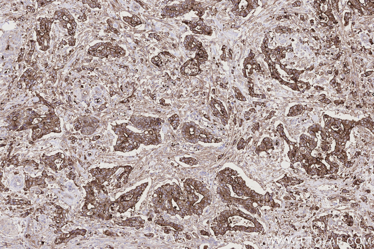 Immunohistochemical analysis of paraffin-embedded human rectal cancer tissue slide using KHC2738 (LMO7 IHC Kit).