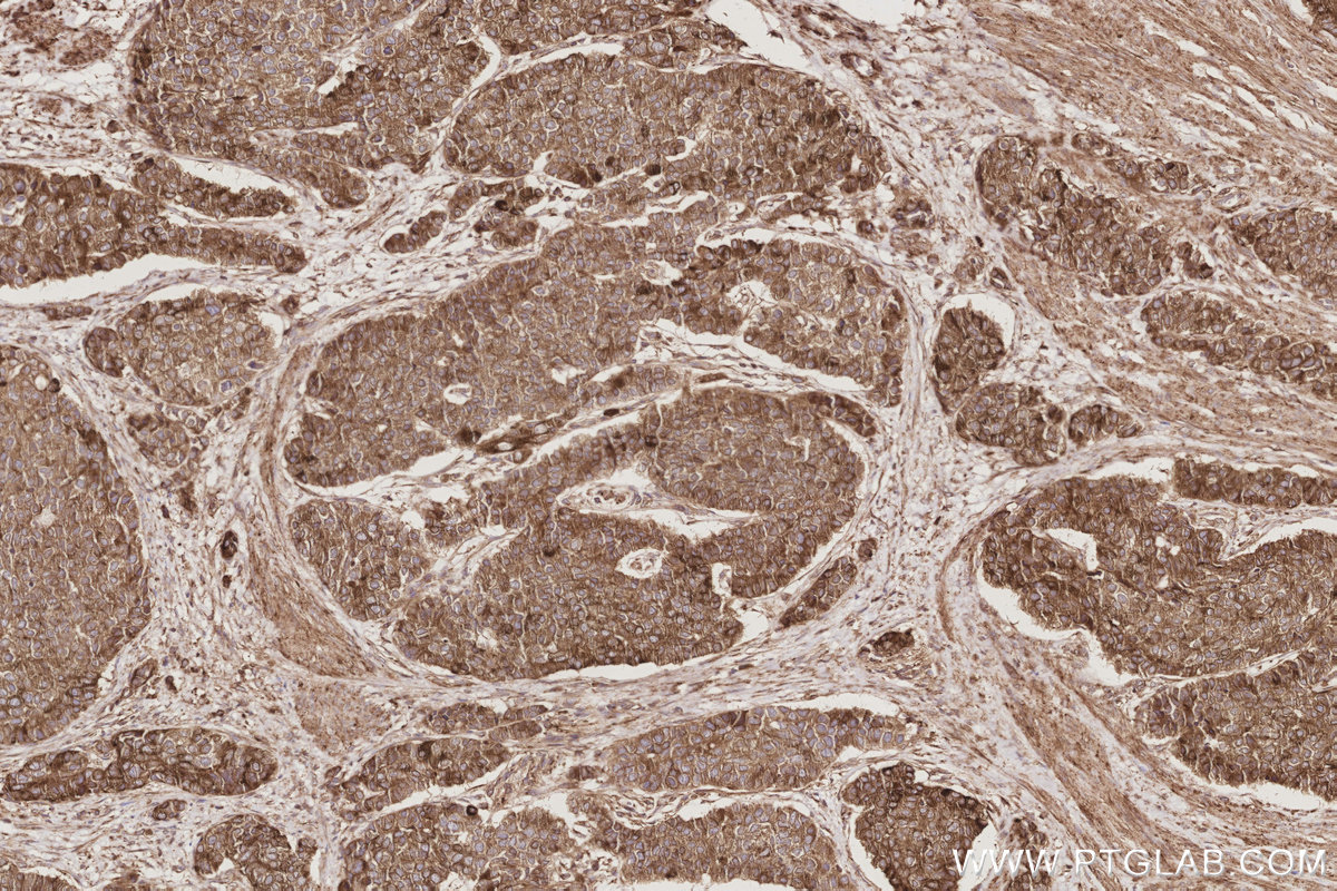 Immunohistochemical analysis of paraffin-embedded human stomach cancer tissue slide using KHC2893 (LNPK/KIAA1715 IHC Kit).