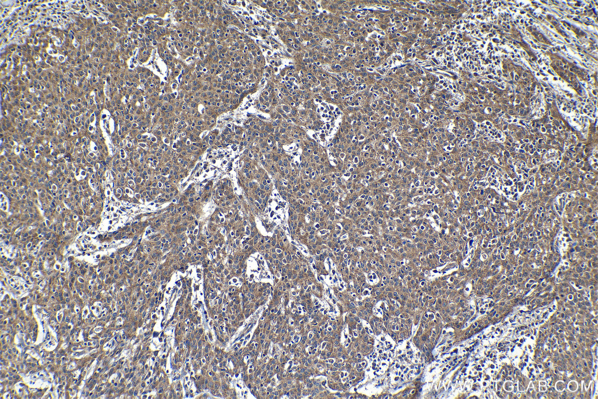 Immunohistochemical analysis of paraffin-embedded human cervical cancer tissue slide using KHC1247 (LONP2 IHC Kit).