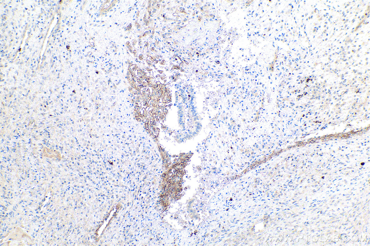 Immunohistochemical analysis of paraffin-embedded human ovary tumor tissue slide using KHC0823 (LOXL2 IHC Kit).