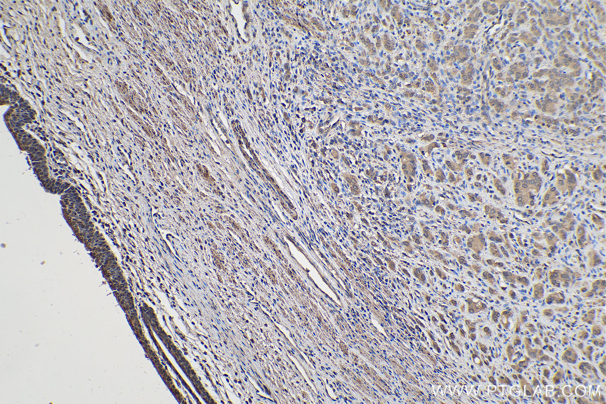 Immunohistochemical analysis of paraffin-embedded human prostate cancer tissue slide using KHC0302 (LPIN1 IHC Kit).