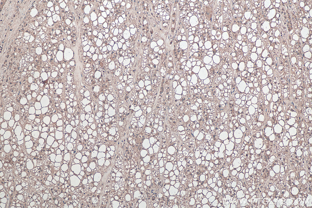 Immunohistochemical analysis of paraffin-embedded human liver cancer tissue slide using KHC0302 (LPIN1 IHC Kit).