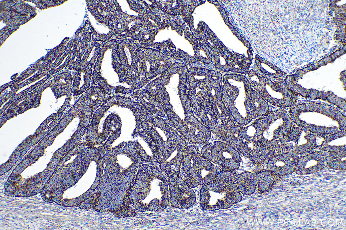 Immunohistochemical analysis of paraffin-embedded human endometrial cancer tissue slide using KHC0166 (LRPPRC IHC Kit).