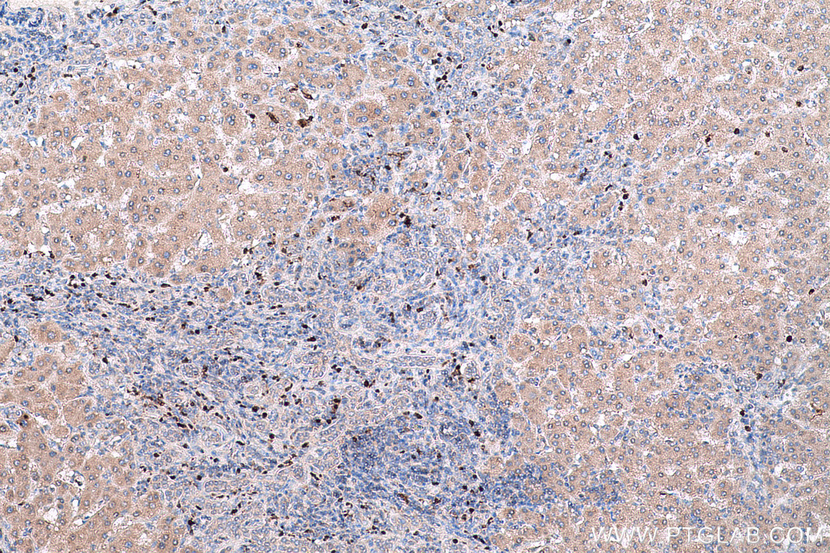 Immunohistochemical analysis of paraffin-embedded human liver cancer tissue slide using KHC0763 (LTF IHC Kit).