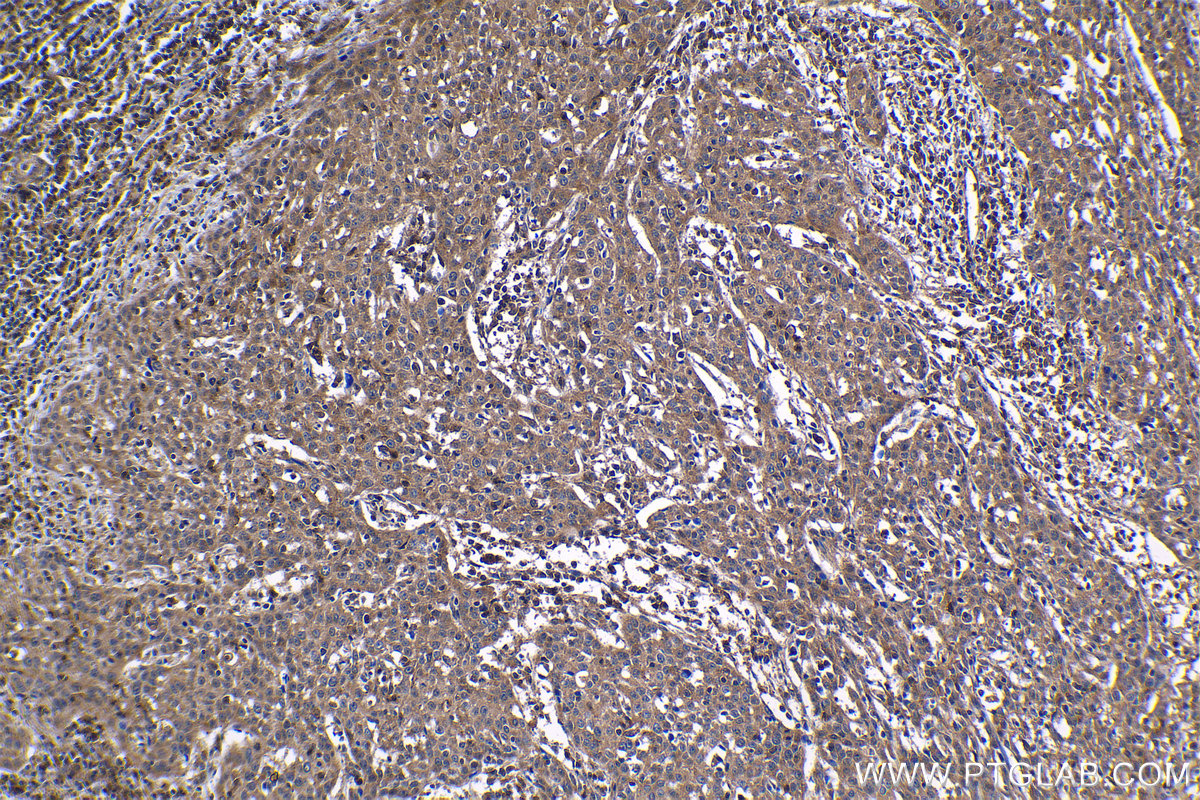 Immunohistochemical analysis of paraffin-embedded human cervical cancer tissue slide using KHC1219 (LYN IHC Kit).