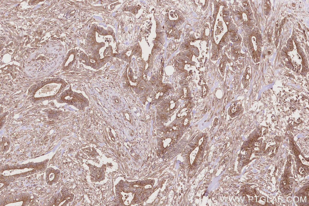 Immunohistochemical analysis of paraffin-embedded human rectal cancer tissue slide using KHC2856 (LZTS2 IHC Kit).