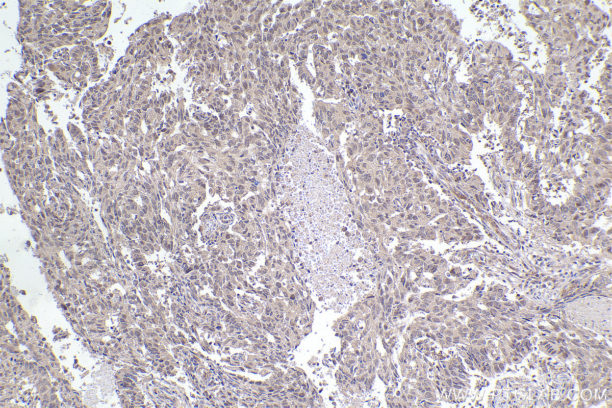 Immunohistochemical analysis of paraffin-embedded human lung cancer tissue slide using KHC2476 (MAD2L1BP IHC Kit).