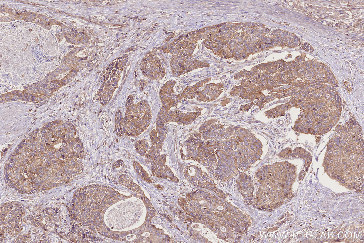 Immunohistochemical analysis of paraffin-embedded human stomach cancer tissue slide using KHC2741 (MADD IHC Kit).