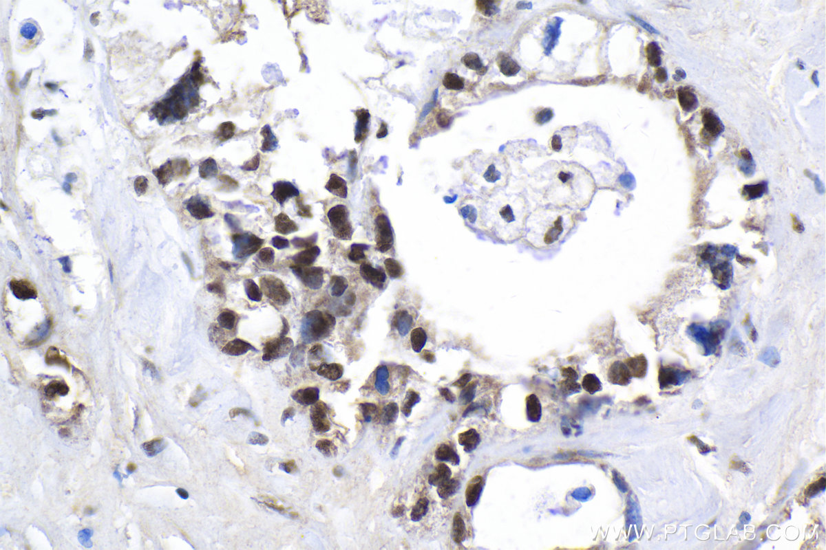 Immunohistochemical analysis of paraffin-embedded human pancreas cancer tissue slide using KHC1999 (MAFF IHC Kit).