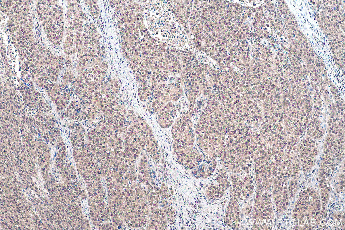 Immunohistochemical analysis of paraffin-embedded human stomach cancer tissue slide using KHC0856 (MAGOH IHC Kit).