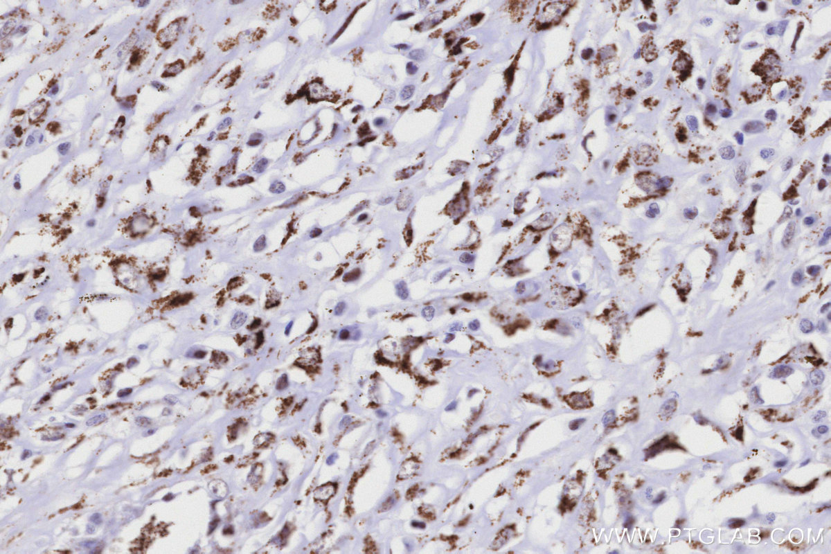 Immunohistochemical analysis of paraffin-embedded human colon cancer tissue slide using KHC3204 (MAOB IHC Kit).
