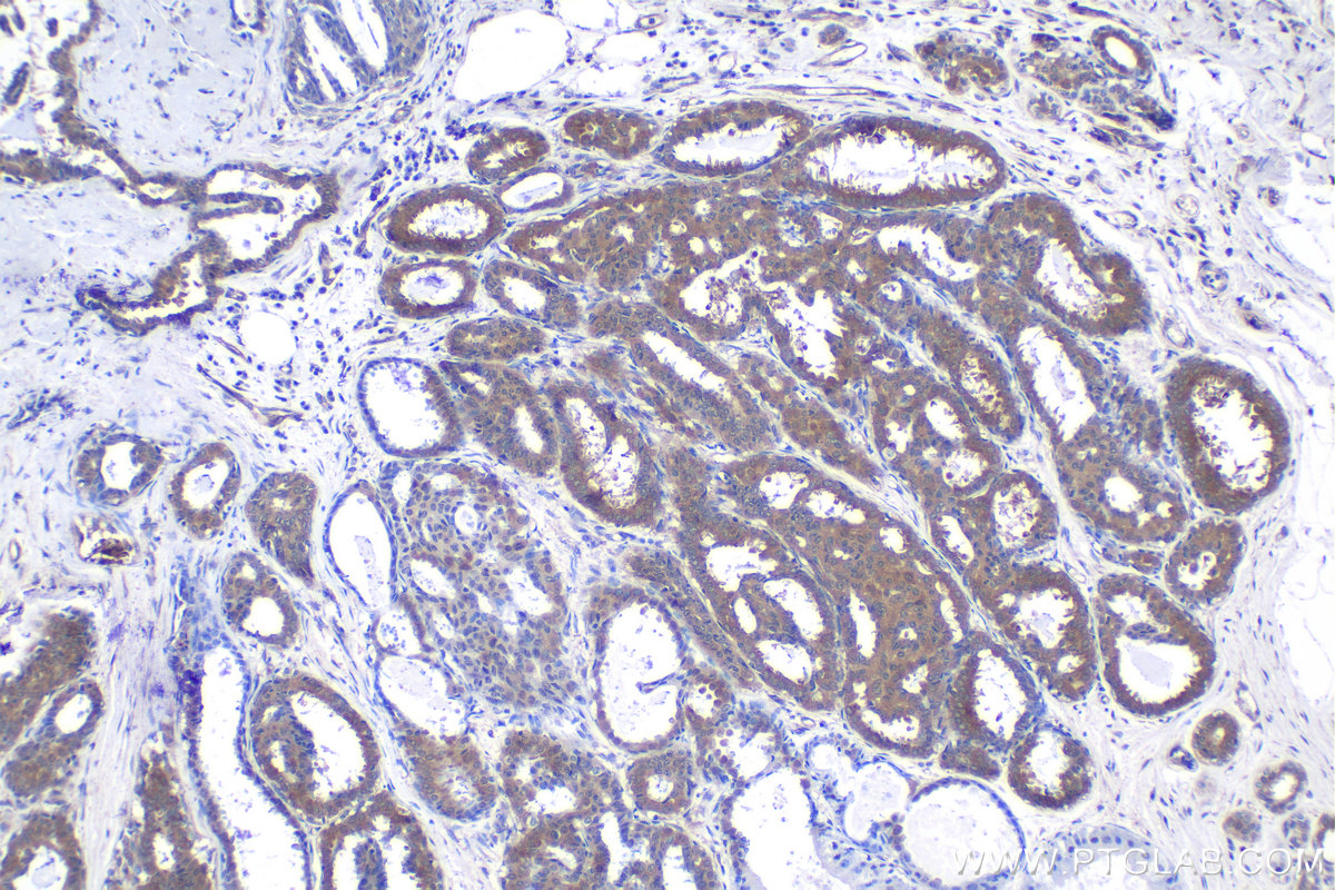 Immunohistochemical analysis of paraffin-embedded human breast cancer tissue slide using KHC0986 (MAP2K2 IHC Kit).