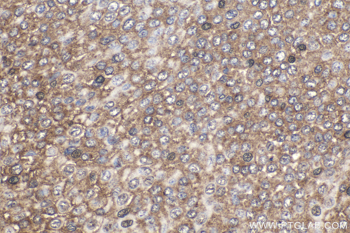 Immunohistochemical analysis of paraffin-embedded human urothelial carcinoma tissue slide using KHC2080 (MAP3K7/TAK1 IHC Kit).