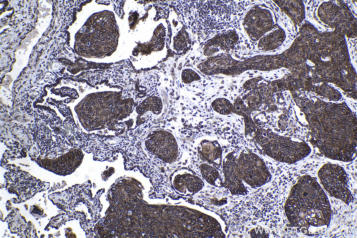 Immunohistochemical analysis of paraffin-embedded human lung cancer tissue slide using KHC1236 (MAP7 IHC Kit).