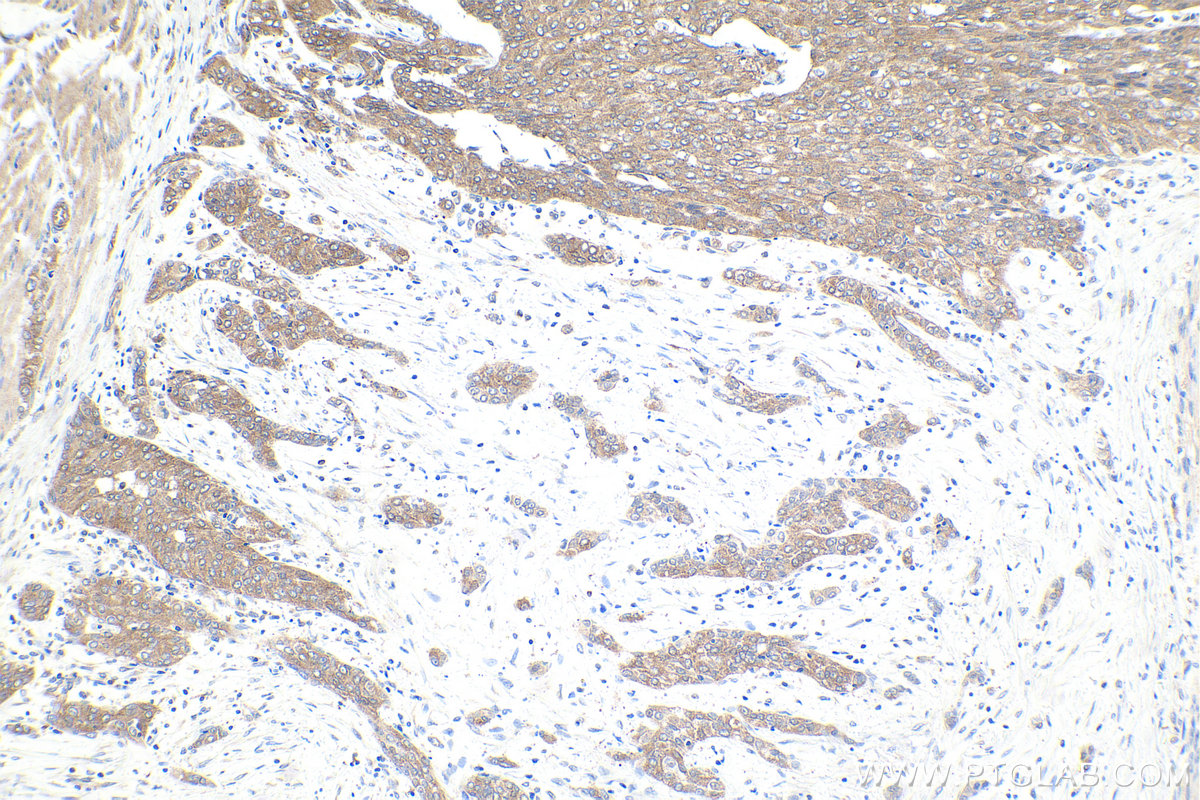 Immunohistochemical analysis of paraffin-embedded human urothelial carcinoma tissue slide using KHC1626 (MAPK10 IHC Kit).