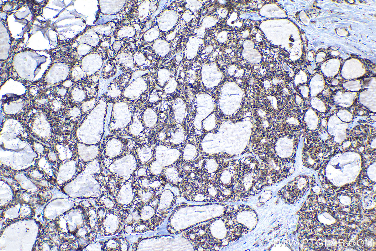 Immunohistochemical analysis of paraffin-embedded human thyroid cancer tissue slide using KHC1287 (MAPKBP1 IHC Kit).