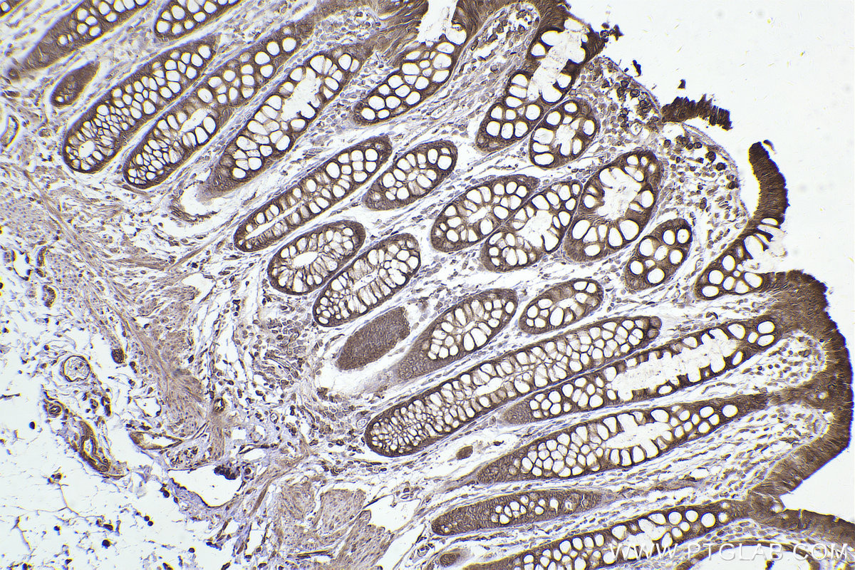 Immunohistochemical analysis of paraffin-embedded human rectal cancer tissue slide using KHC2491 (MAPRE2 IHC Kit).