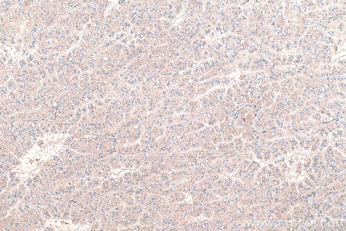 Immunohistochemical analysis of paraffin-embedded human lung cancer tissue slide using KHC0948 (MARCKSL1 IHC Kit).