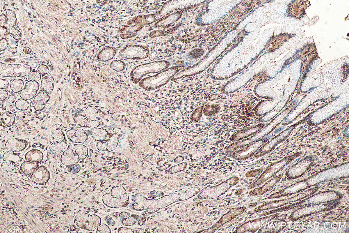 Immunohistochemical analysis of paraffin-embedded human stomach cancer tissue slide using KHC0854 (MAT2B IHC Kit).