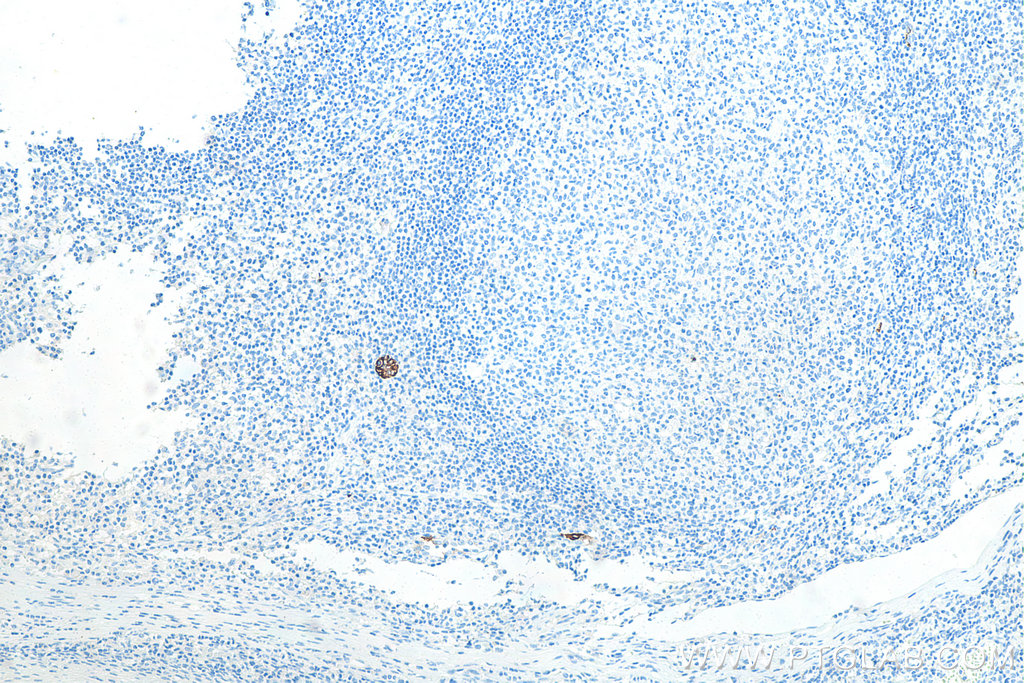 Immunohistochemical analysis of paraffin-embedded human tonsillitis tissue slide using KHC0025 (MAdCAM1 IHC Kit).