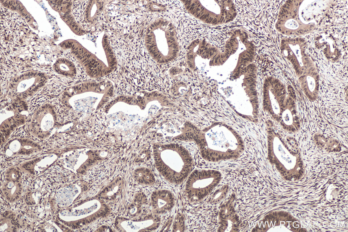 Immunohistochemical analysis of paraffin-embedded human colon cancer tissue slide using KHC0433 (MBNL1 IHC Kit).