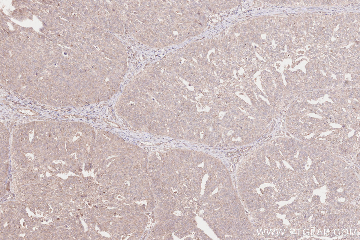 Immunohistochemical analysis of paraffin-embedded human ovary cancer tissue slide using KHC2602 (MBOAT1 IHC Kit).