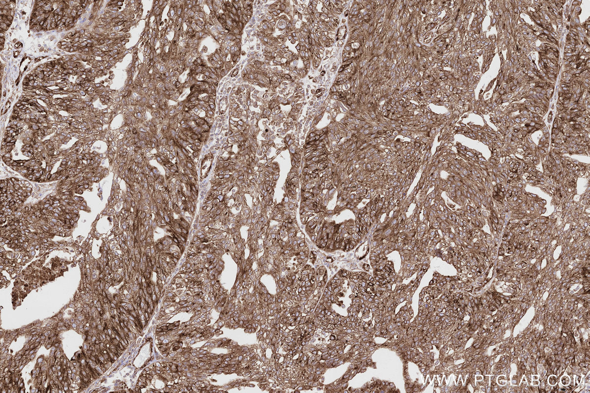 Immunohistochemical analysis of paraffin-embedded human ovary cancer tissue slide using KHC2808 (MBOAT7 IHC Kit).